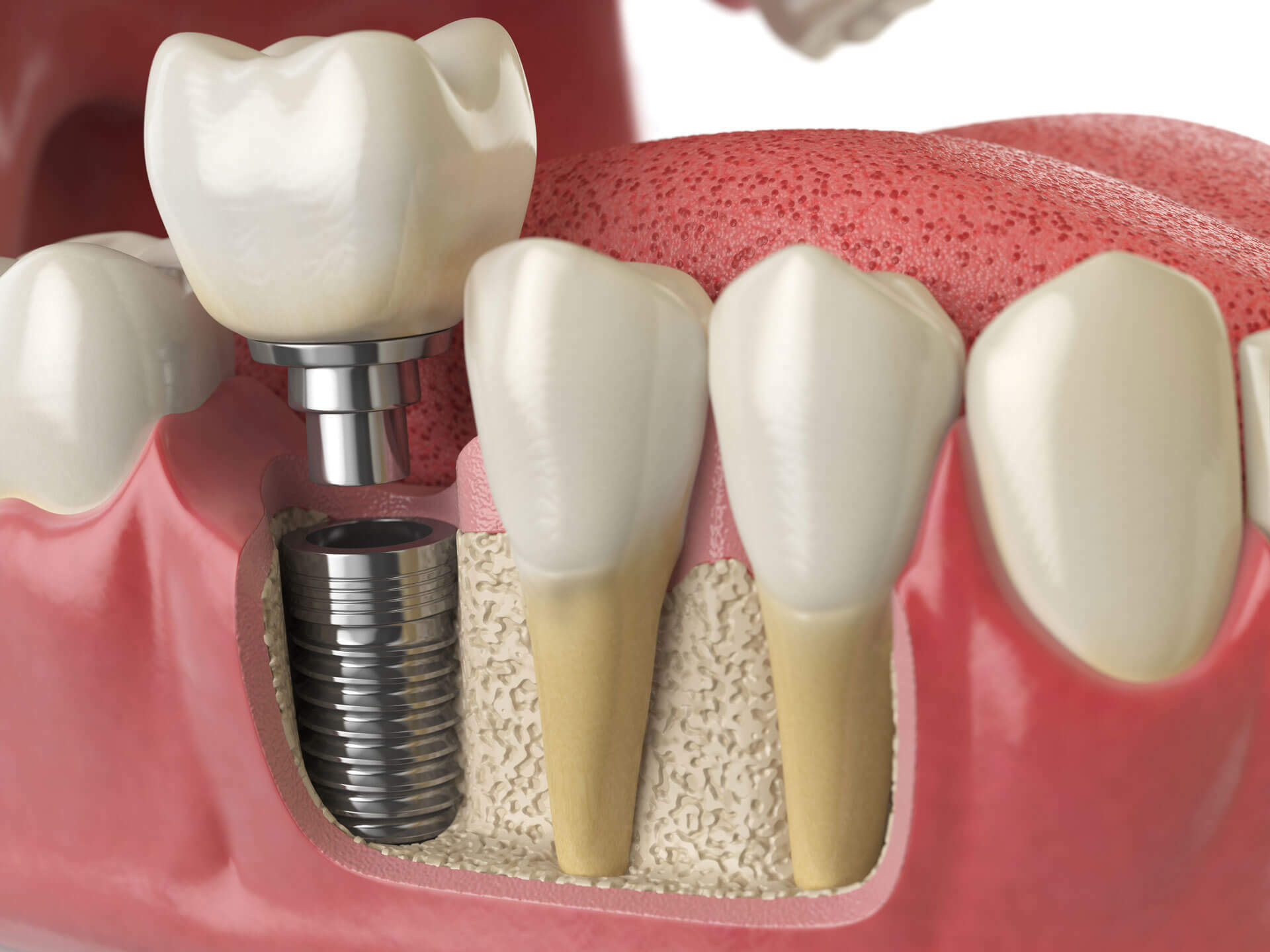 Dr Nikola Bakiš dental corner, dentalni implanti su savršena estetska i funkcionalna nadoknada za izgubljeni zub | stomatologija, zdravlje i prevencija, magazin